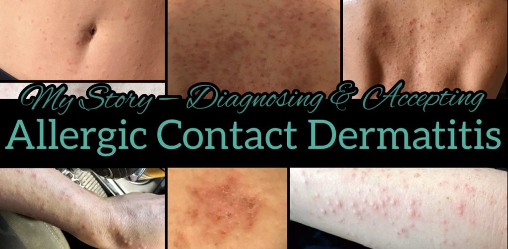 My Personal Story Of Allergic Contact Dermatitis – Diagnosis And