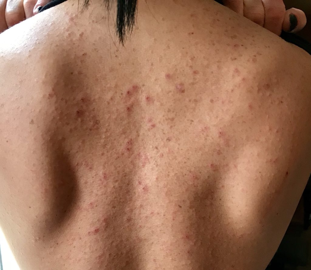When I developed a red itchy skin rash, I wasn't sure what it was. Almost 2 years later, I'm writing about it. This is my story of being diagnosed with allergic contact dermatitis, and accepting my adult onset allergy to fragrance, formaldehyde and imidazolidinyl urea
