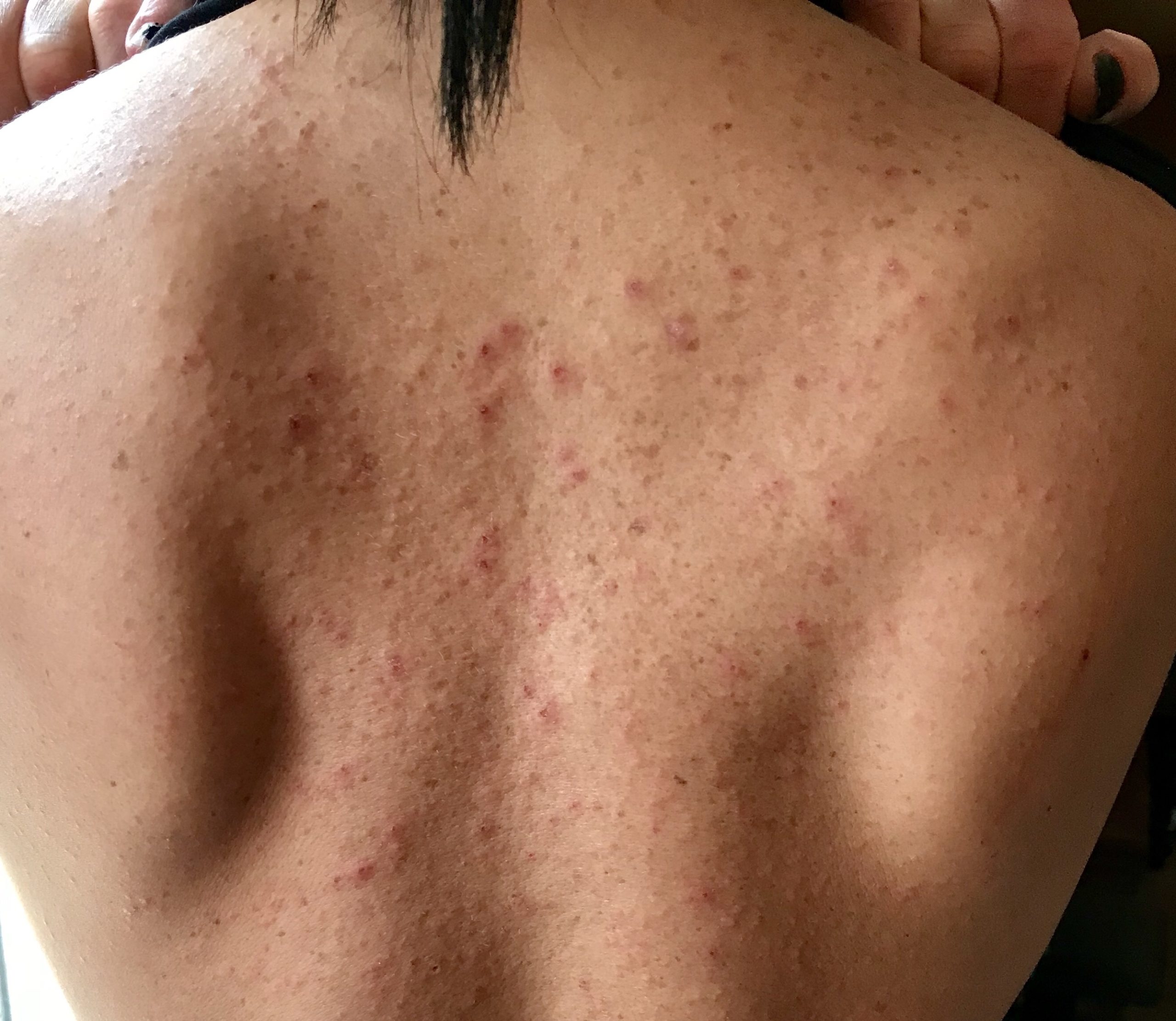 dermatitis allergic heathermangieri