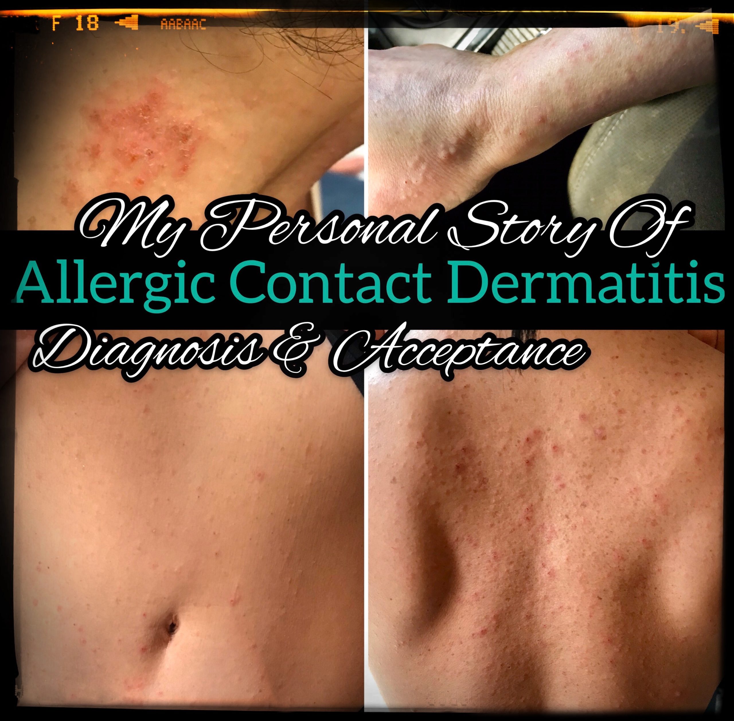 My Personal Story Of Allergic Contact Dermatitis – Diagnosis And