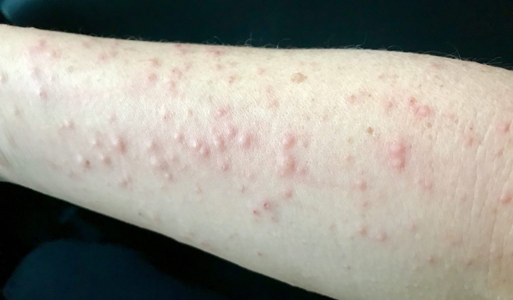 When I developed a red itchy skin rash, I wasn't sure what it was. Almost 2 years later, I'm writing about it. This is my story of being diagnosed with allergic contact dermatitis, and accepting my adult onset allergy to fragrance, formaldehyde and imidazolidinyl urea.