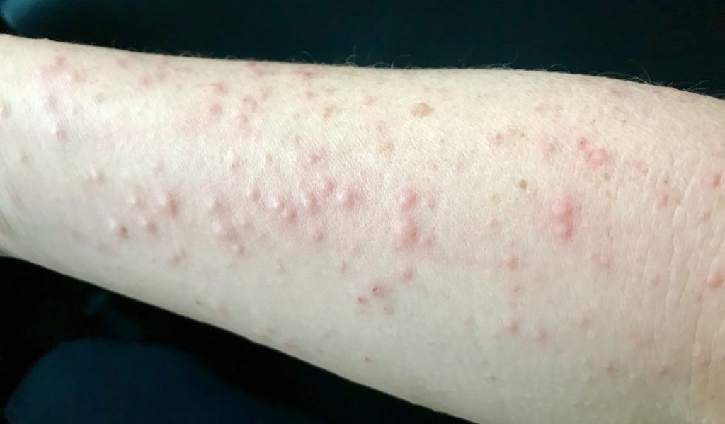 My Personal Story Of Allergic Contact Dermatitis – Diagnosis And